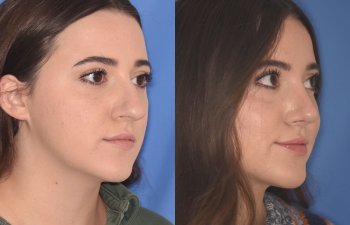 patient before and after rhinoplasty procedure