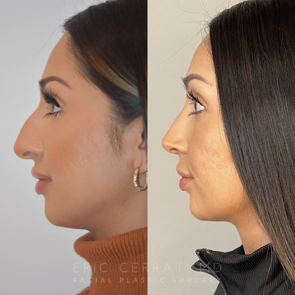 patient before and after rhinoplasty procedure
