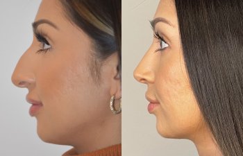 patient before and after rhinoplasty procedure