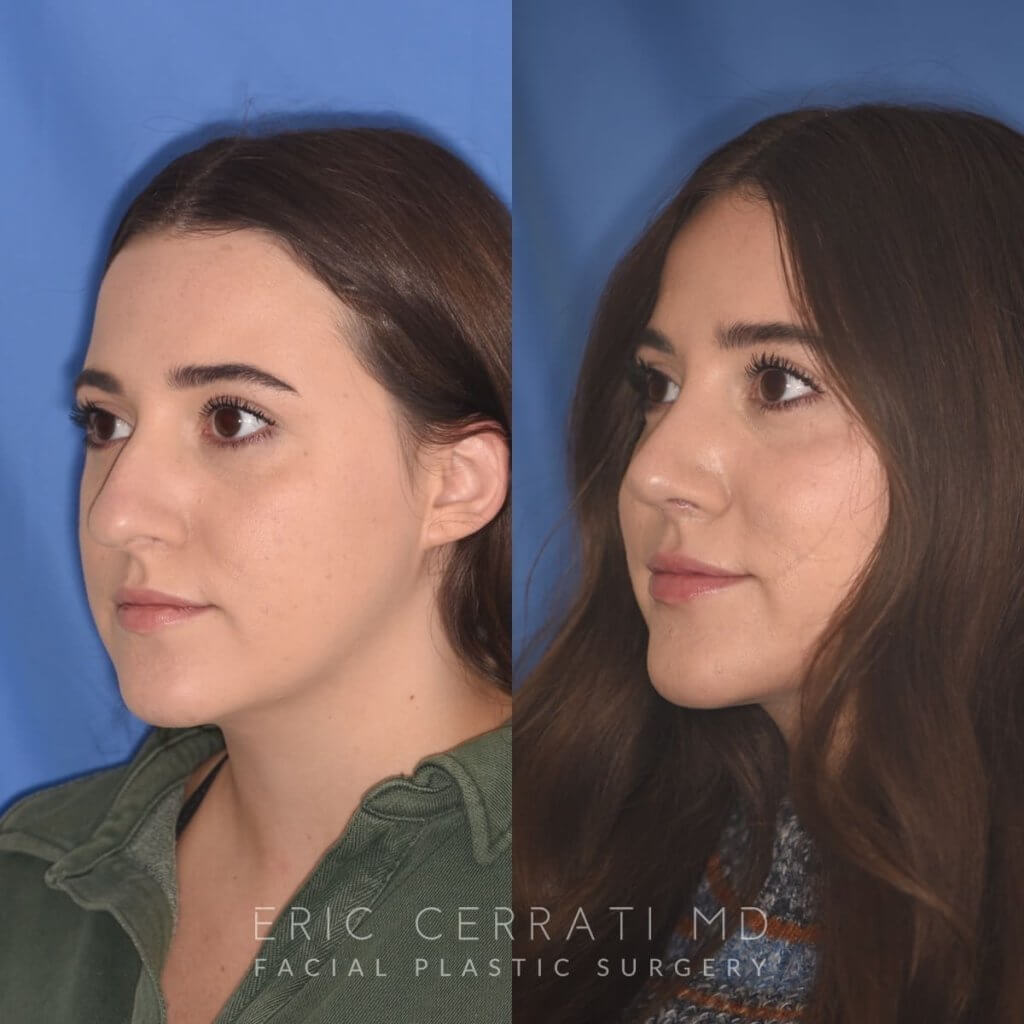 patient before and after rhinoplasty procedure