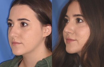patient before and after rhinoplasty procedure