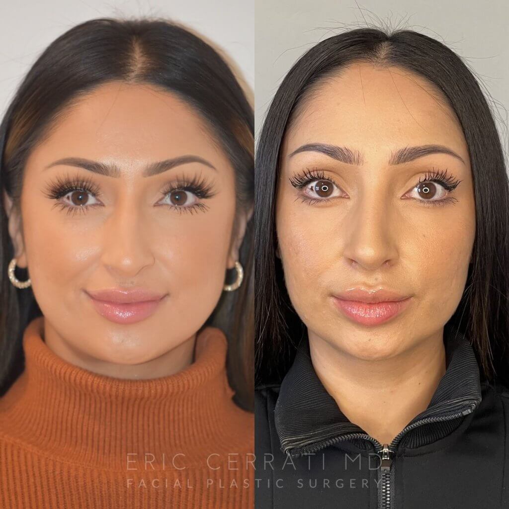 patient before and after rhinoplasty procedure