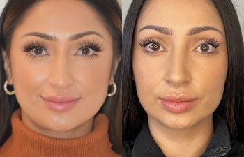 patient before and after rhinoplasty procedure