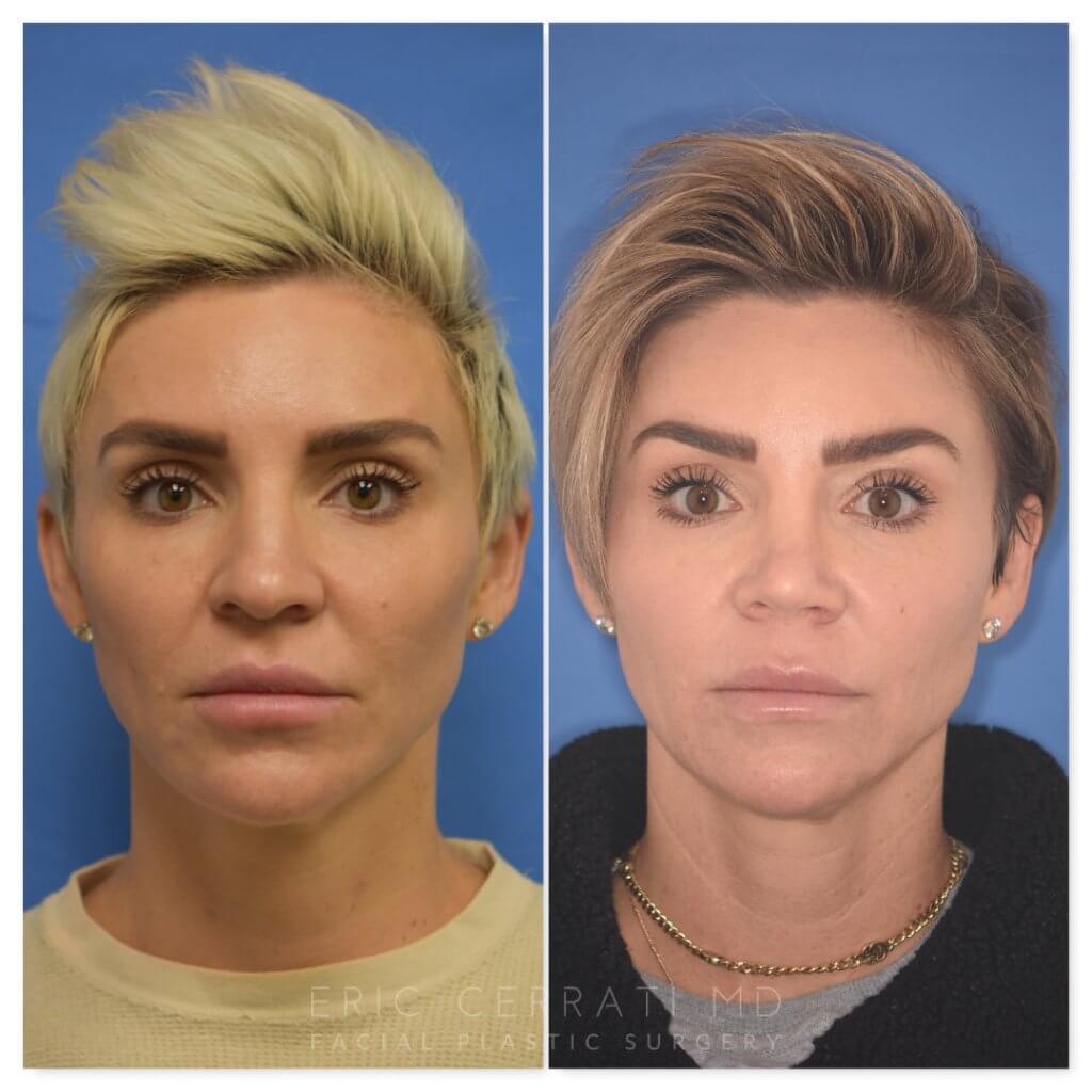 patient before and after rhinoplasty procedure