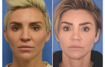 patient before and after rhinoplasty procedure