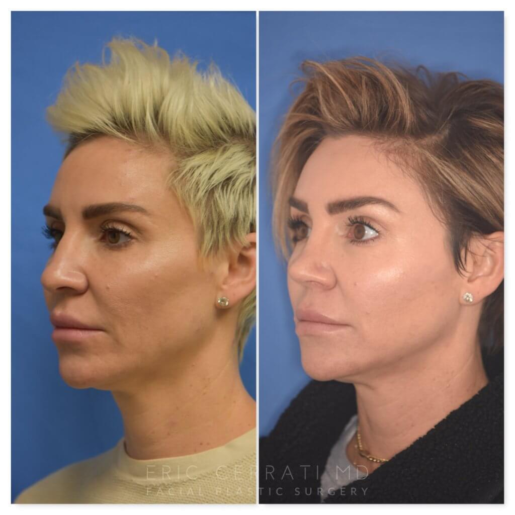 patient before and after rhinoplasty procedure