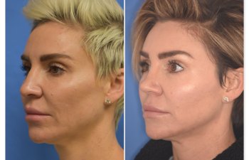 patient before and after rhinoplasty procedure