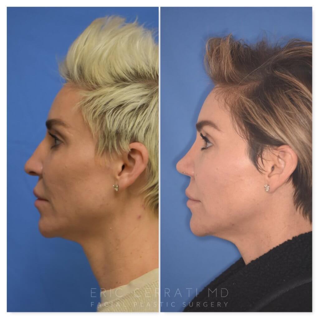 patient before and after rhinoplasty procedure