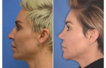 patient before and after rhinoplasty procedure