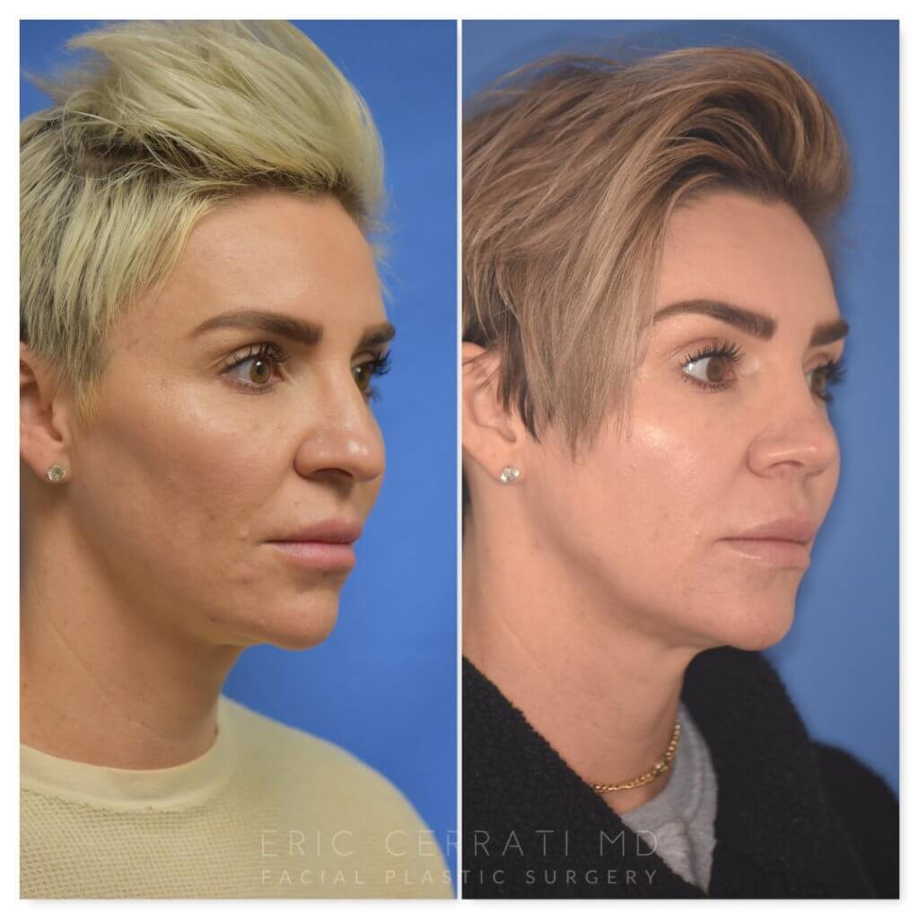 patient before and after rhinoplasty procedure