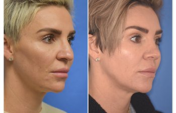 patient before and after rhinoplasty procedure