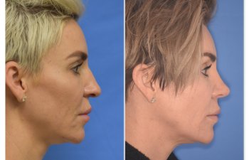 patient before and after rhinoplasty procedure