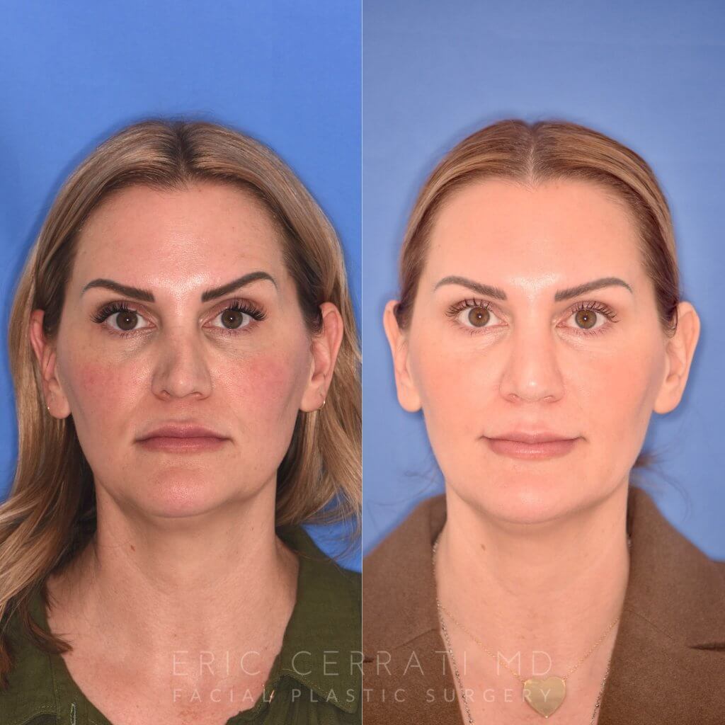 41YR - 5 Months Postop: Revision Rhinoplasty before after photo front