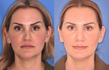 41YR - 5 Months Postop: Revision Rhinoplasty before after photo front