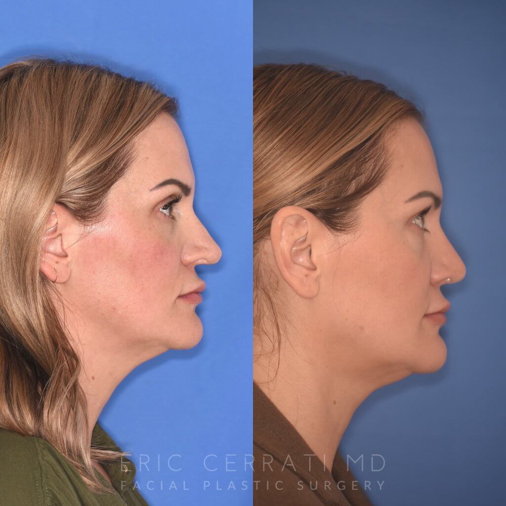 41YR - 5 Months Postop: Revision Rhinoplasty before after photo right