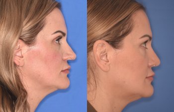 41YR - 5 Months Postop: Revision Rhinoplasty before after photo right