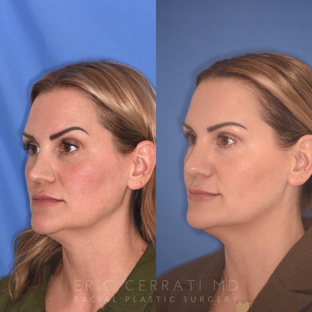 41YR - 5 Months Postop: Revision Rhinoplasty before after photo left