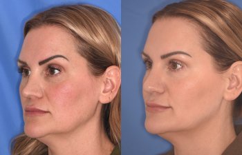 41YR - 5 Months Postop: Revision Rhinoplasty before after photo left