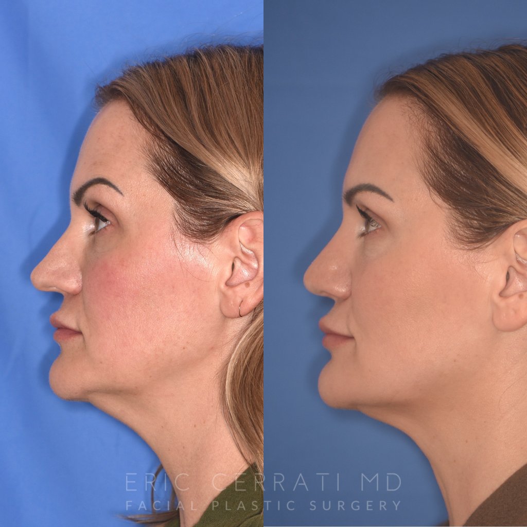 41YR - 5 Months Postop: Revision Rhinoplasty before after photo left
