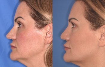 41YR - 5 Months Postop: Revision Rhinoplasty before after photo left