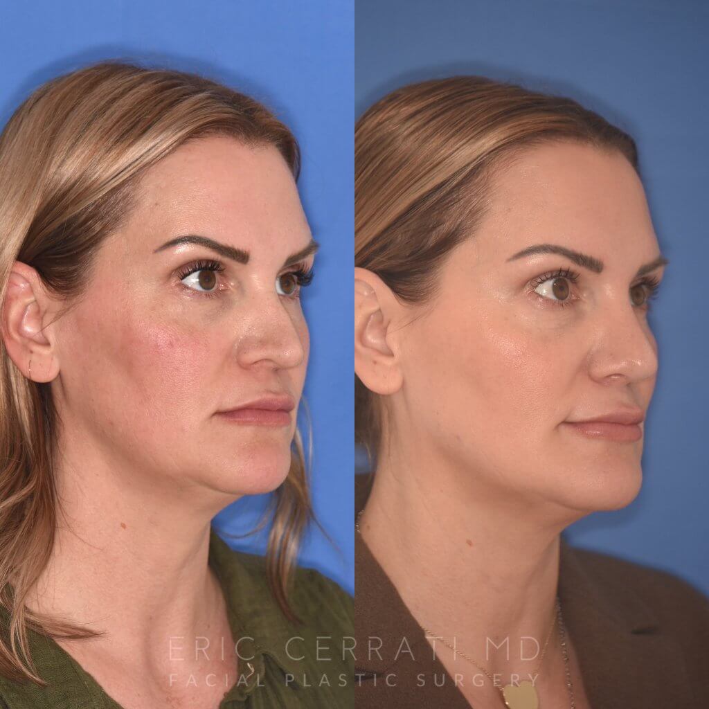 41YR - 5 Months Postop: Revision Rhinoplasty before after photo right side