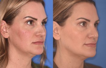 41YR - 5 Months Postop: Revision Rhinoplasty before after photo right side