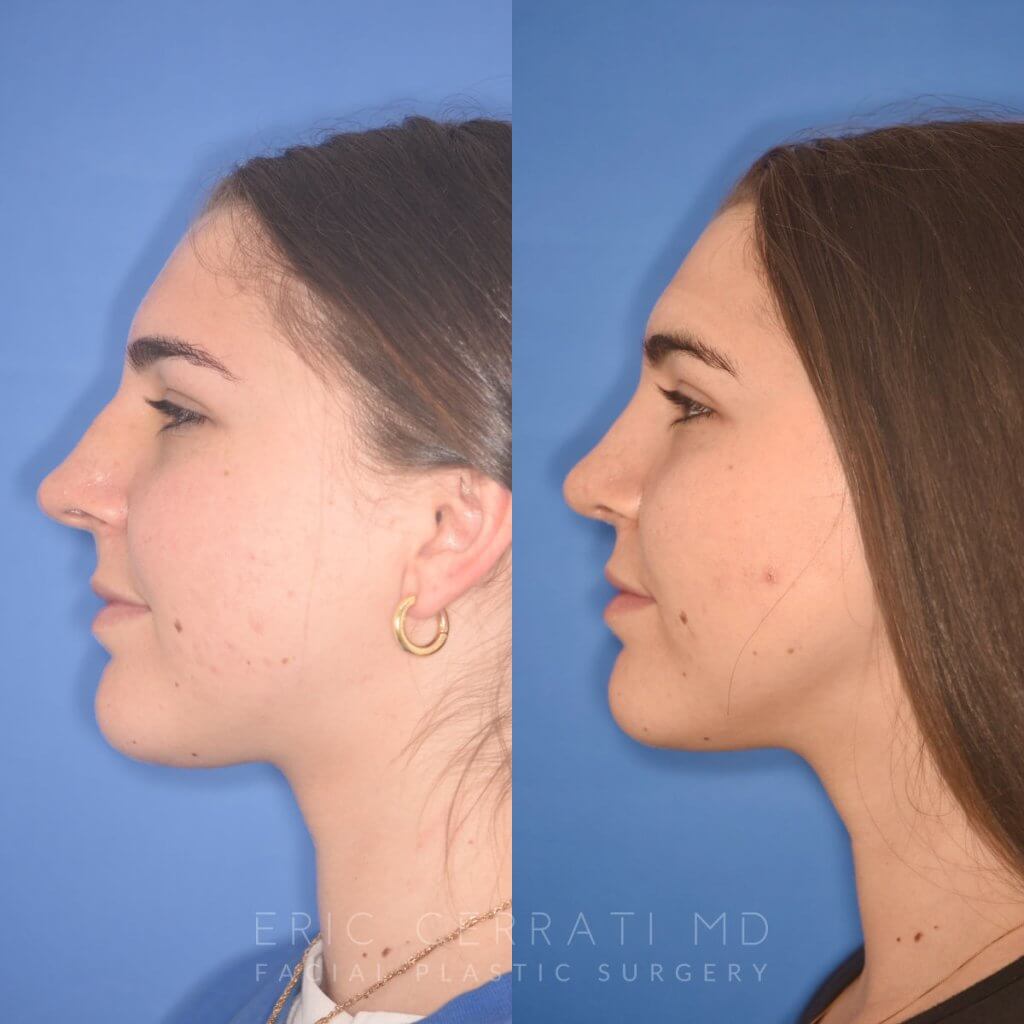 patient before and after rhinoplasty procedure