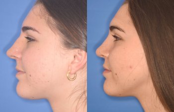 patient before and after rhinoplasty procedure