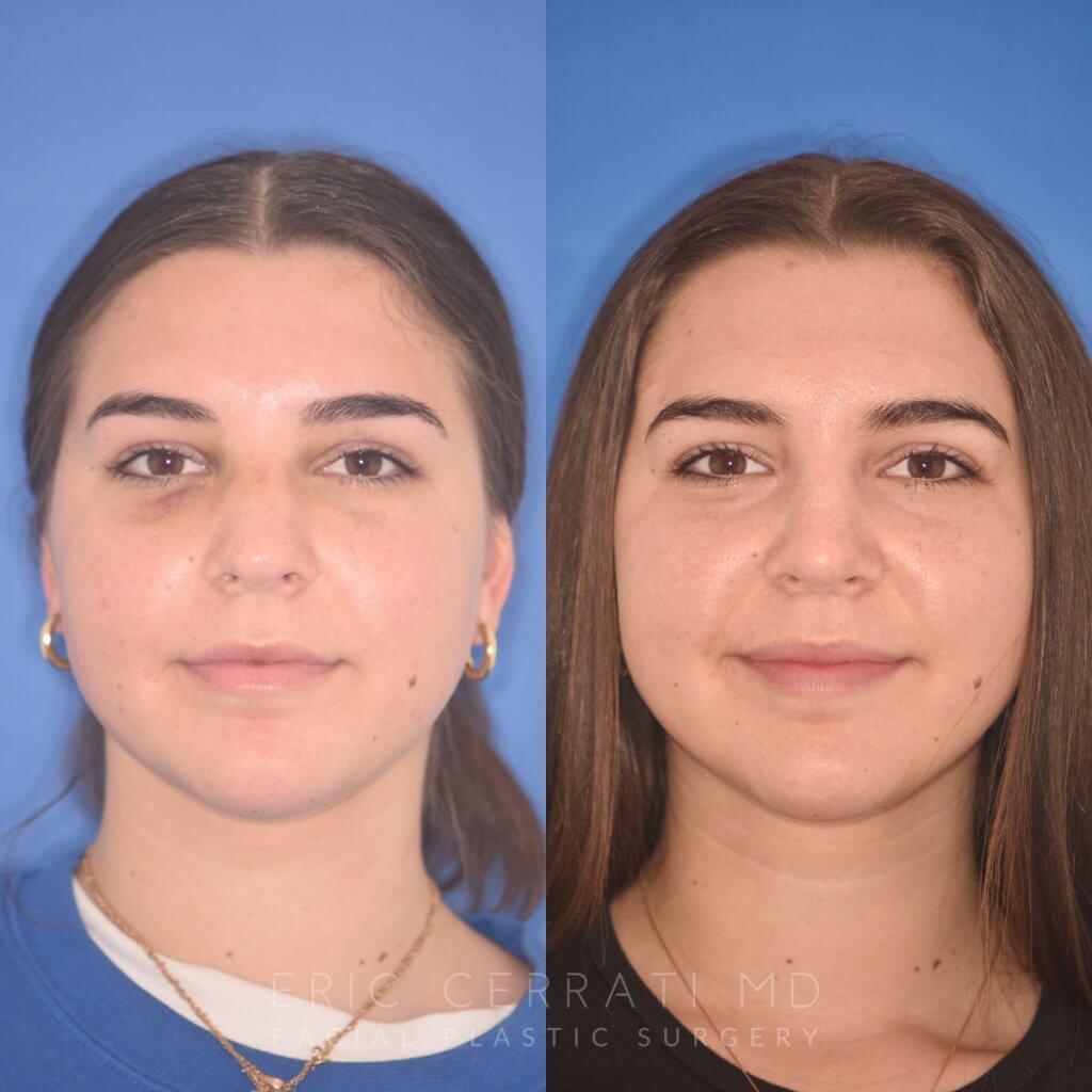 patient before and after rhinoplasty procedure