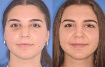 patient before and after rhinoplasty procedure