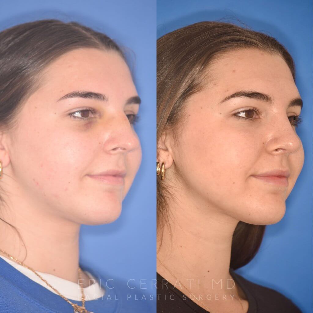 patient before and after rhinoplasty procedure