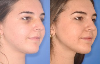 patient before and after rhinoplasty procedure
