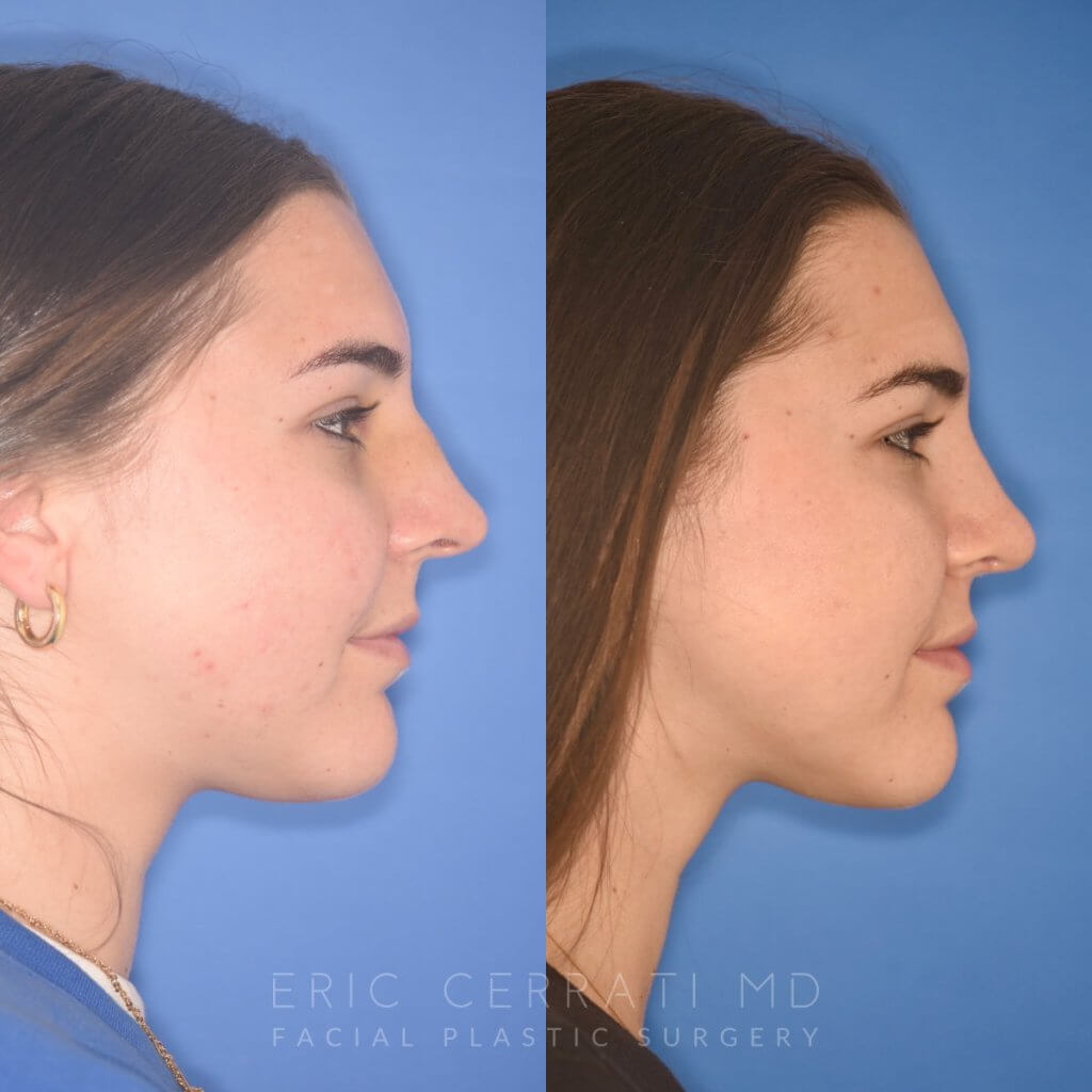 patient before and after rhinoplasty procedure