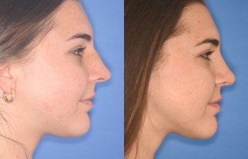 patient before and after rhinoplasty procedure