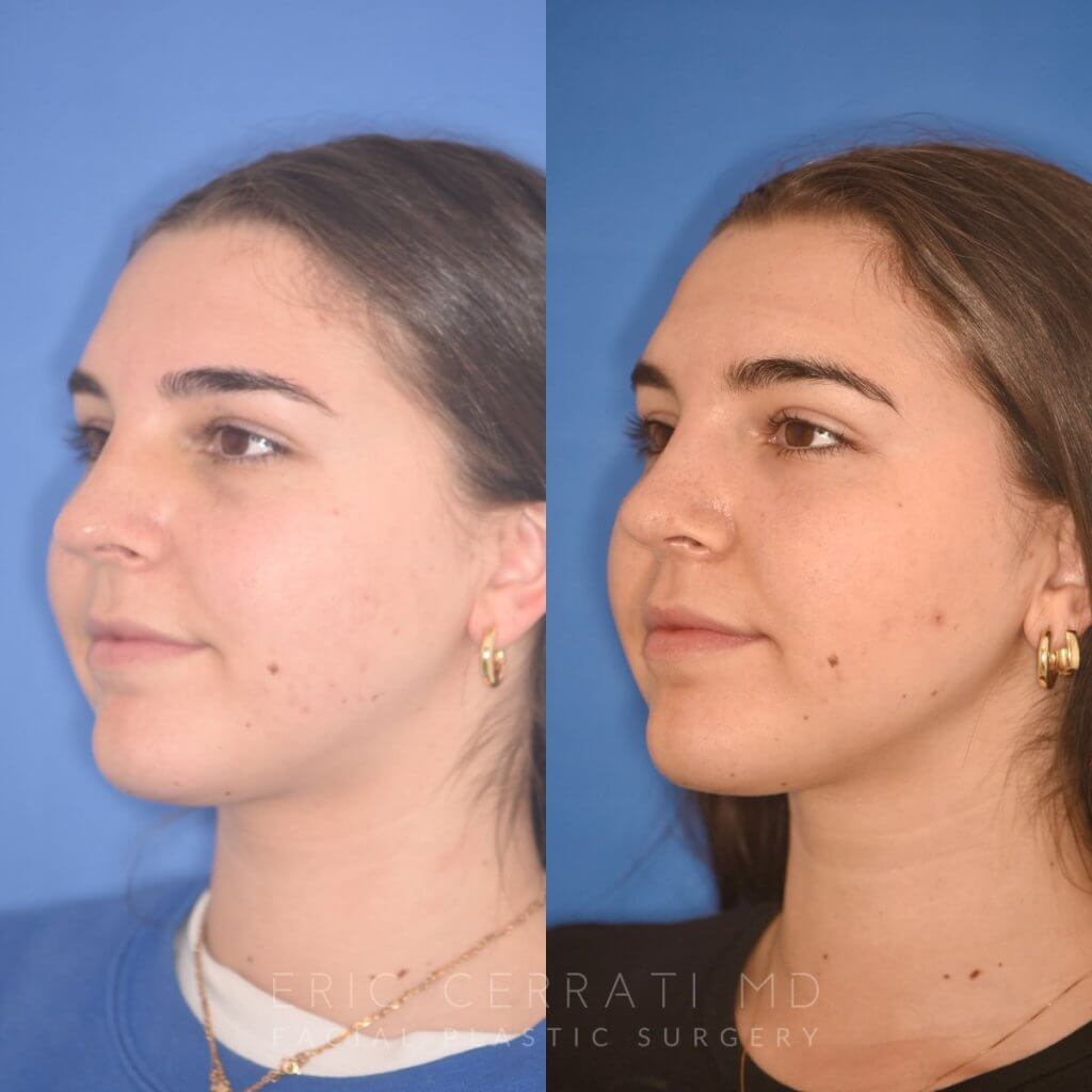patient before and after rhinoplasty procedure