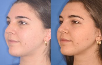 patient before and after rhinoplasty procedure