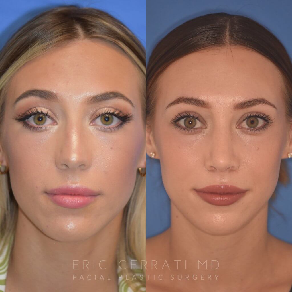 patient before and after Rhinoplasty