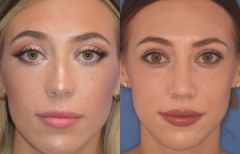 patient before and after Rhinoplasty