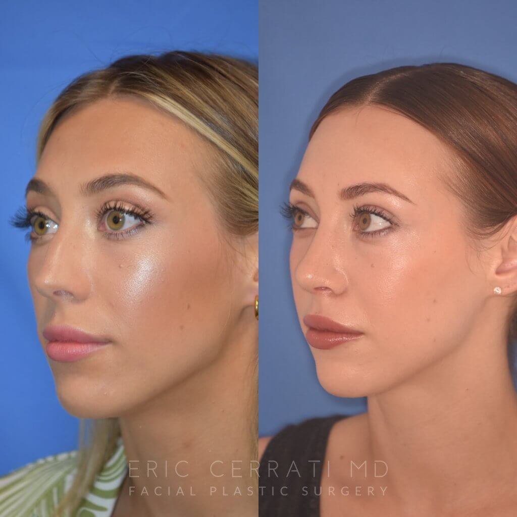 patient before and after Rhinoplasty