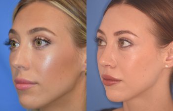 patient before and after Rhinoplasty