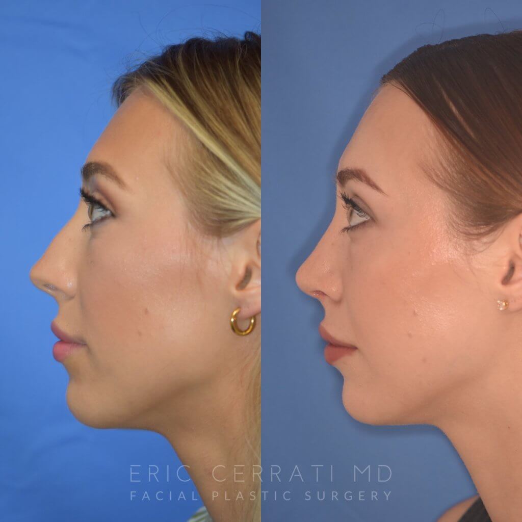 patient before and after Rhinoplasty