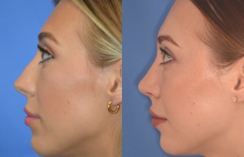 patient before and after Rhinoplasty