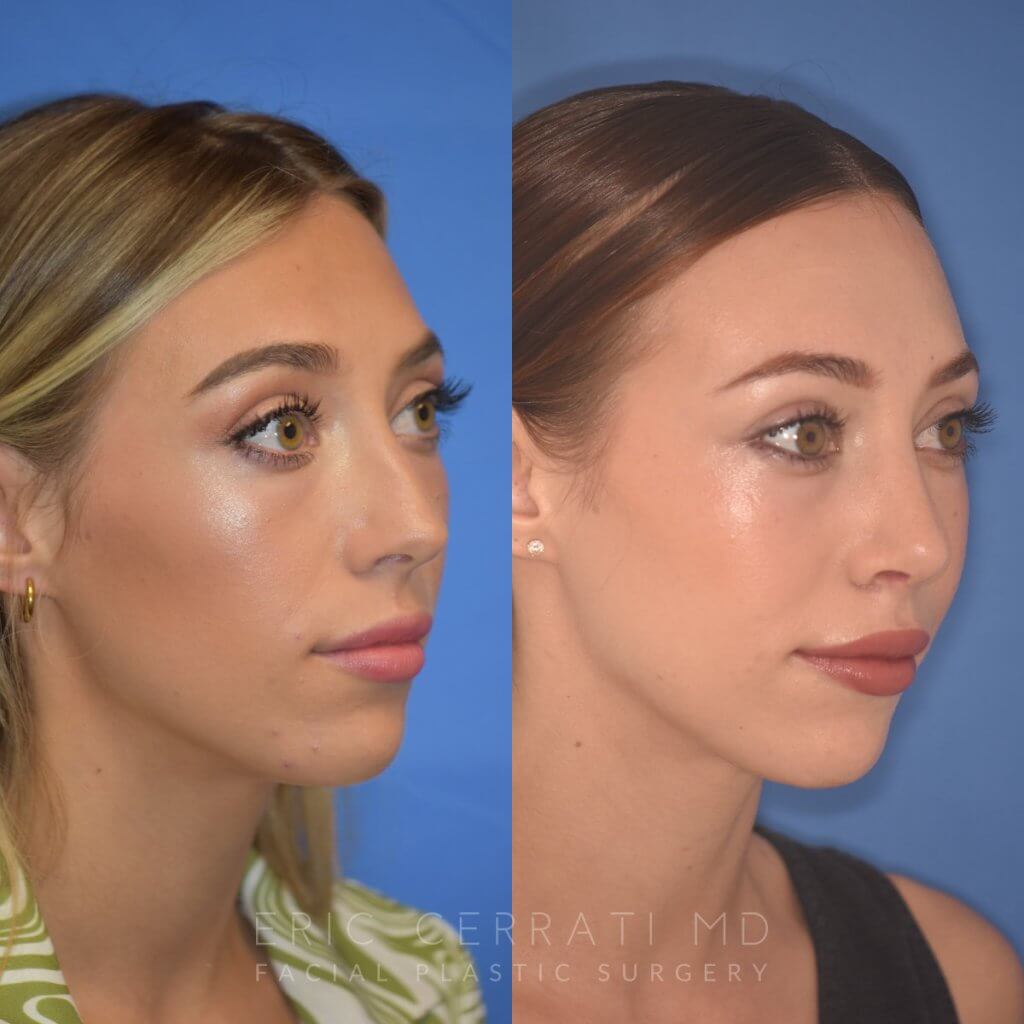 patient before and after Rhinoplasty
