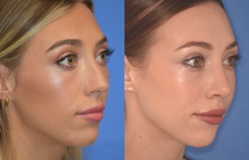 patient before and after Rhinoplasty