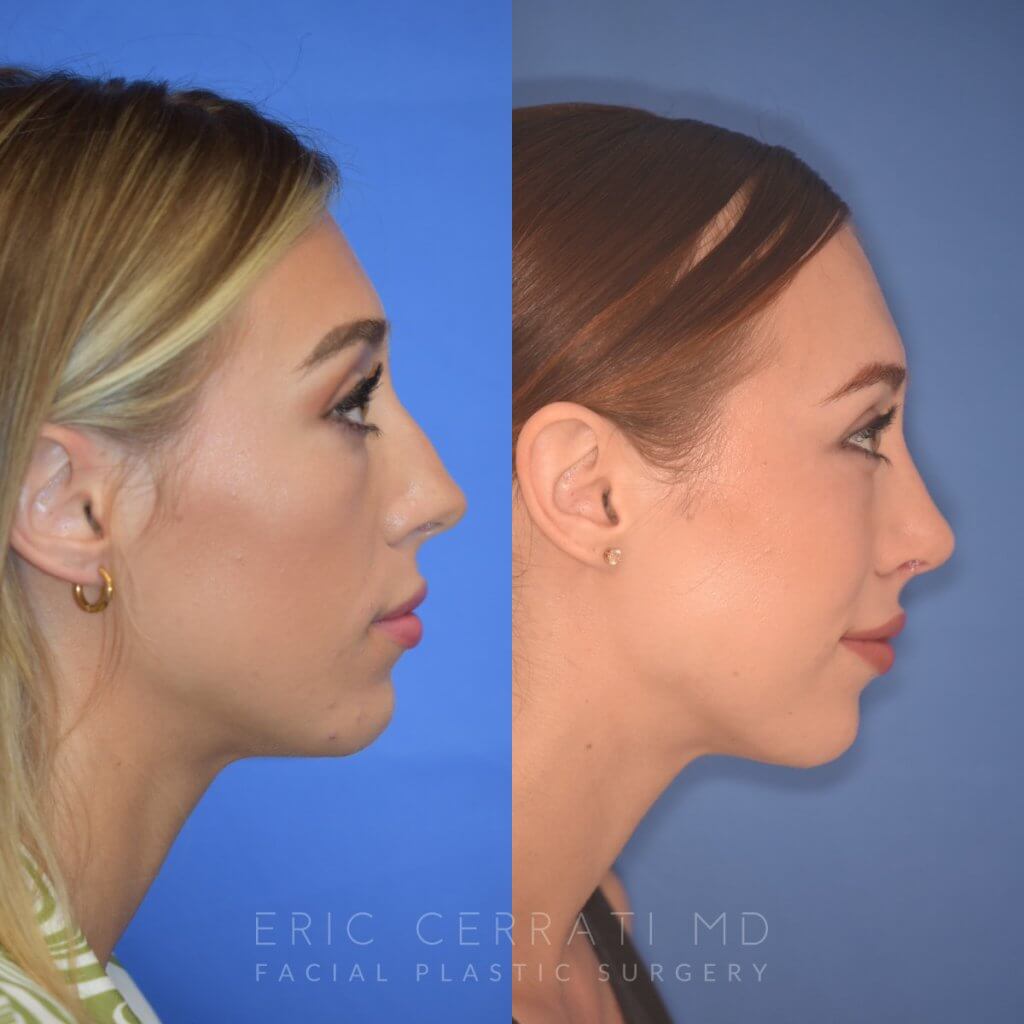 patient before and after Rhinoplasty