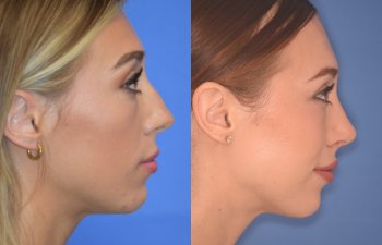 patient before and after Rhinoplasty