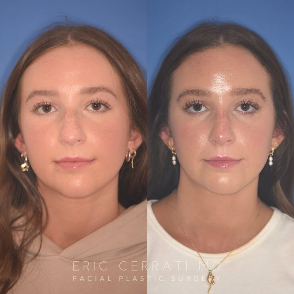 patient before and after rhinoplasty procedure