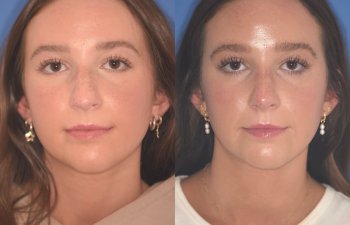patient before and after rhinoplasty procedure