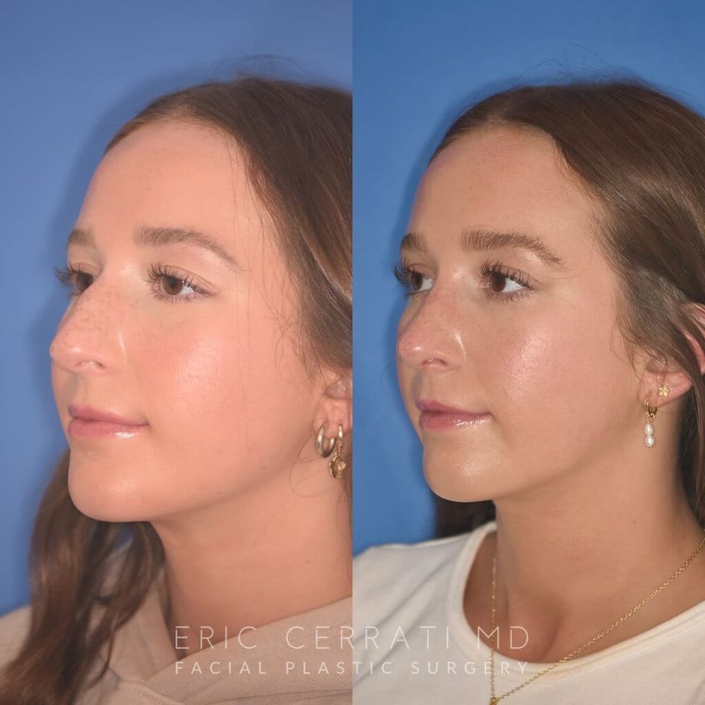 patient before and after rhinoplasty procedure