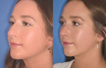 patient before and after rhinoplasty procedure